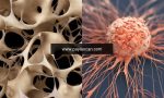 osteoporoz-ve-kanser-bagi-ZDsUDRfO.jpg